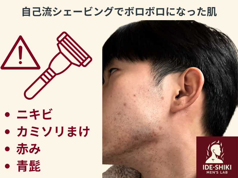 間違えたシェービングで肌がボロボロになった筆者の画像