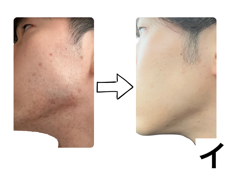 筆者のビフォーアフター。1